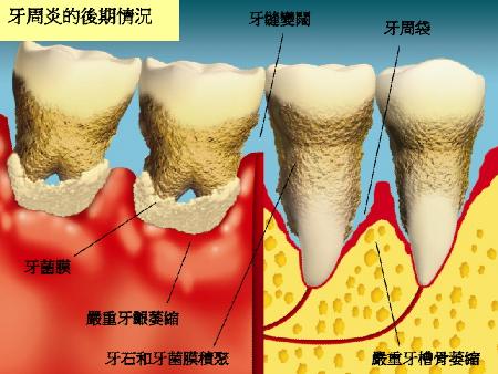 让牙医失业的牙周病终极疗法