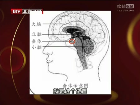 垂体瘤包括功能性垂体瘤和无功能性垂体瘤两大类,老年人群多发的是无