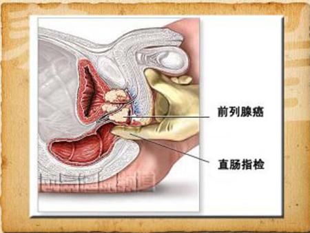 前列腺示意图