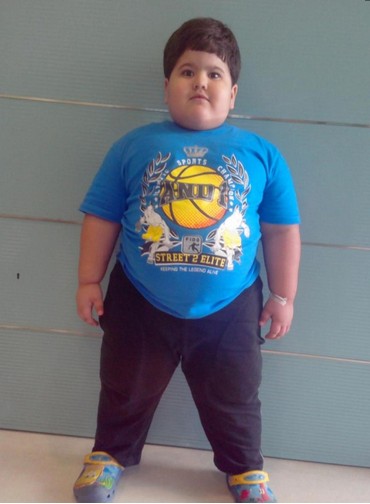 印度4岁男孩重88斤实施胃切除术减重