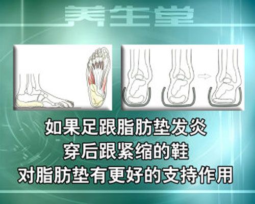 如果足跟脂垫发炎,穿后跟紧缩的鞋子对脂肪垫有更好的支持作用