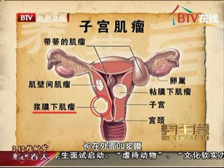 买了好医保忘了说子宫肌瘤 子宫肌瘤算保险里的轻症吗